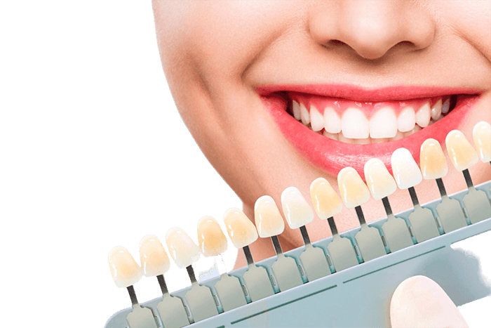Facetas dentárias.