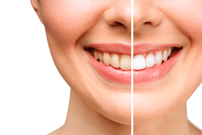 Facetas dentárias.