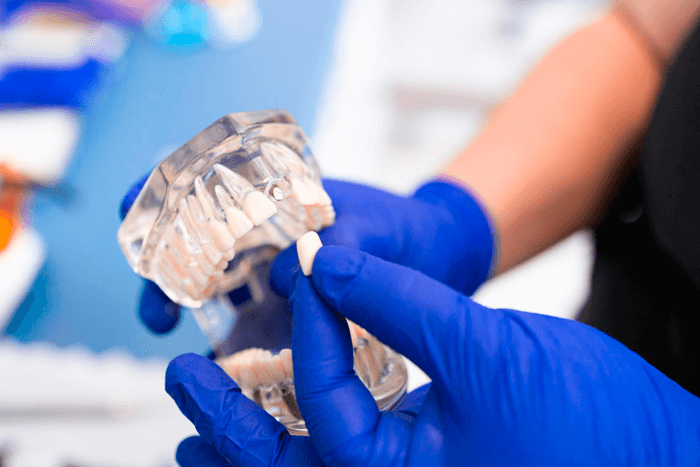 Facetas dentárias.